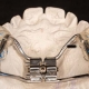 ortodontik-apareyler